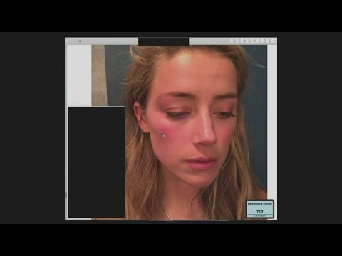 Johnny Depp’s lawyers question alleged injuries Amber Heard documented after altercation with Depp