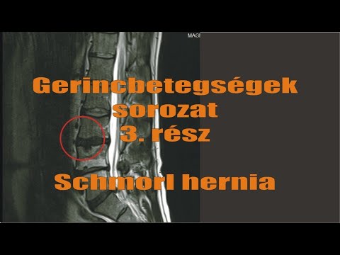 Gerincbetegségek sorozat 3. rész: Schmorl hernia